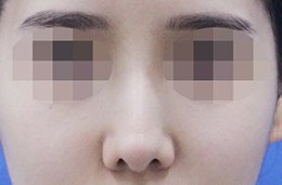 코성형 수술 전 정면(눈 모자이크)