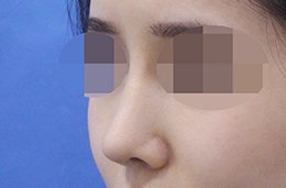 코성형 수술 후 2개월 45도