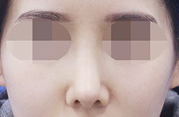 코성형 수술 후 2개월 정면