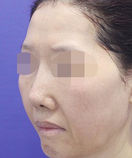 안면거상·지방이식 수술 전 45도