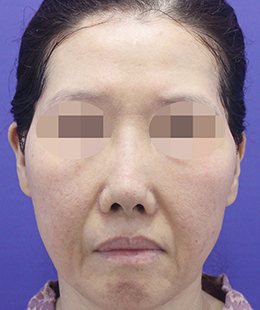 안면거상·지방이식 수술 전 정면