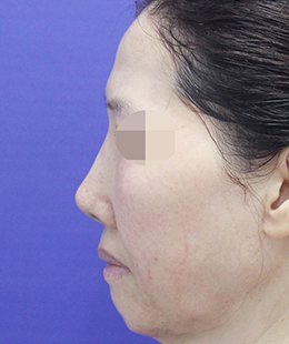 안면거상·지방이식 수술 전 측면