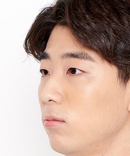 눈·코·무턱보형물 수술 전 45도