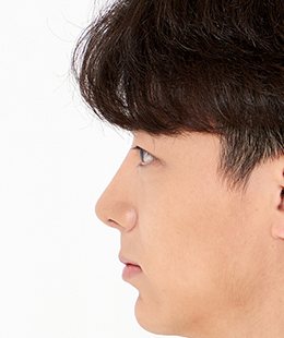 눈·코·무턱보형물 수술 후 3개월 측면