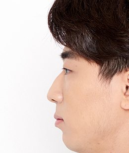 눈·코·무턱보형물 수술 전 측면