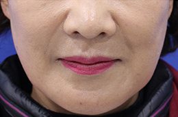 필러(팔자) 시술 후 1주일 정면 하관